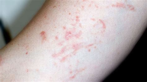 Koebner Phenomenon and Psoriasis Flares