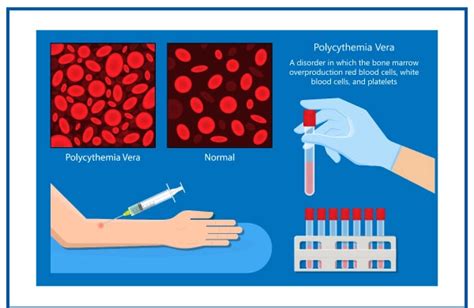 Polycythemia: Symptoms, Causes, Diagnosis & treatment