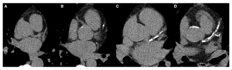 Figure. Example of participants with different CAC score in each risk... | Download Scientific ...