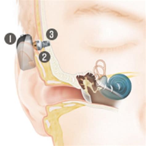 Bone Anchored Hearing Systems | Temple Health