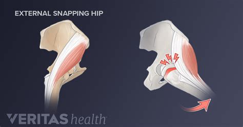 3 Types of Snapping Hip Syndrome