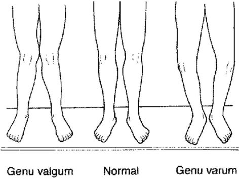 Genu Varum si Genu Valgum la copii | Dr. Andreea Lupu