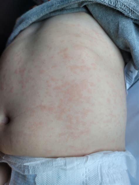 11 month old with rash? After fever any ideas? : r/beyondthebump