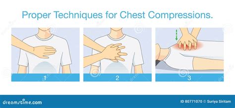 Proper Techniques for Chest Compression. Stock Vector - Illustration of cartoon, attack: 80771070