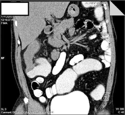 Abdominal CT with contrast showing the appendicular mass | Download Scientific Diagram