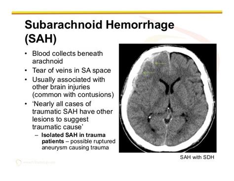 Subarachnoid hemorrhage | Subarachnoid hemorrhage, Brain anatomy and ...