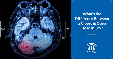 Open Head Injury vs. Closed Head Injury: What Is The Difference?