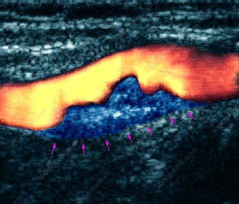 Atheroma plaque, Doppler ultrasound - Stock Image - M175/0299 - Science Photo Library