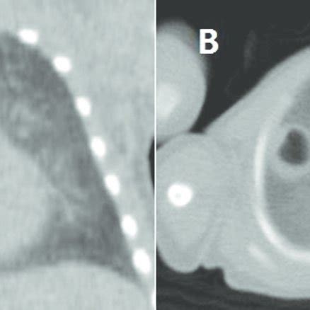 Low dose chest CT with pneumatocele (1.3×1.0 cm) in right upper lobe ...