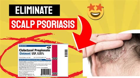 Say Goodbye to Scalp Psoriasis with Clobetasol Propionate: A Game-Changer! - YouTube