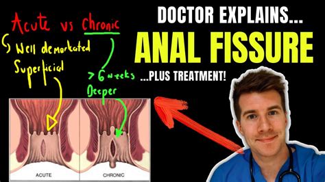 Doctor explains ANAL FISSURE, including causes, classification and ...