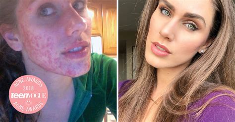 Cassandra Bankson on the Truth Behind Her Cystic Acne | Teen Vogue