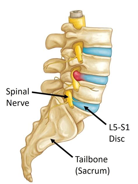 Treating an L5-S1 Disc Herniation: A Case Study - Regenexx