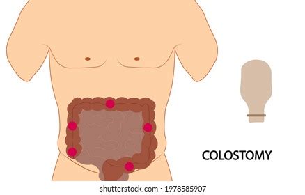 31 Ileostomy disk Images, Stock Photos & Vectors | Shutterstock