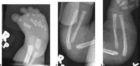 123 Campomelic Dysplasia | Radiology Key