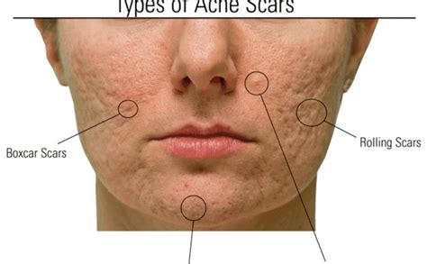 Focus on Different Types of Acne Scars - MedLaserUSA