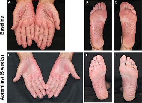 Frontiers | Successful Treatment of Refractory Palmoplantar Pustular Psoriasis With Apremilast ...