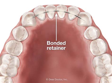 Bonded Retainers - pros and cons