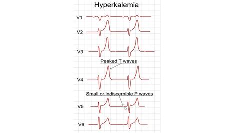 Ecg Of Hyperkalemia