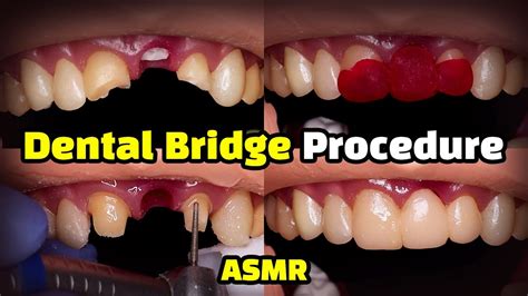 Dental Bridge Procedure - Dental Clinic