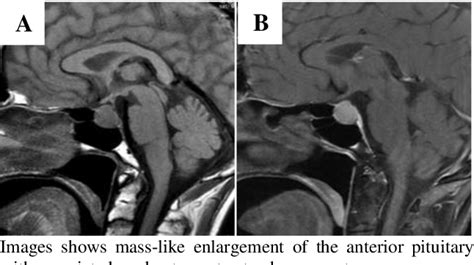 Figure 1 from Spectrum and review of MRI findings in hypophysitis | Semantic Scholar