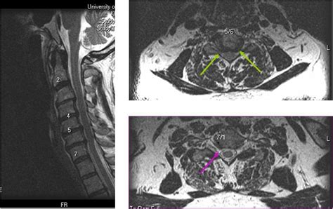 Case 26 - MRI