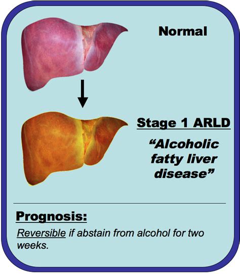 Gallery For > Fatty Liver Alcohol