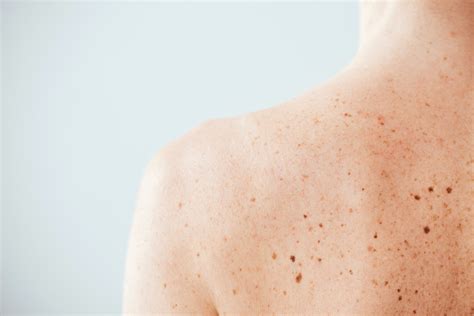 10 Ways to Tell if a Mole Is Cancerous