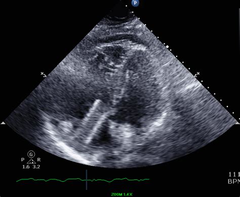 Iliac Vein Stent Migration to the Right Ventricle - American College of Cardiology