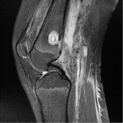 Figure 2 from A Brodie’s abscess with soft tissue collection ...