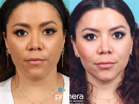 Buccal Fat Removal Before and After Pictures Case 615 | Orlando, Florida | Primera Plastic Surgery