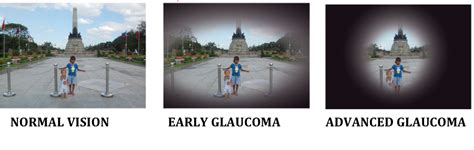 Glaucoma screening tests - Βλέμμα