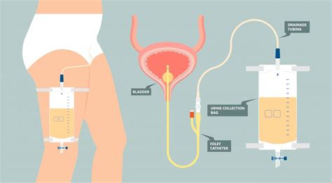 What's a Foley catheter? | Roswell Park Comprehensive Cancer Center ...