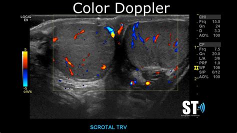 Testicular Torsion Ultrasound Doppler