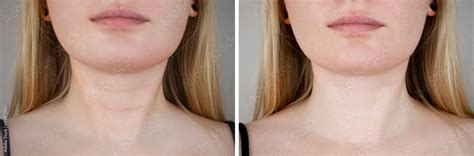 Photos before and after plastic surgery to remove Venus rings. Contour ...