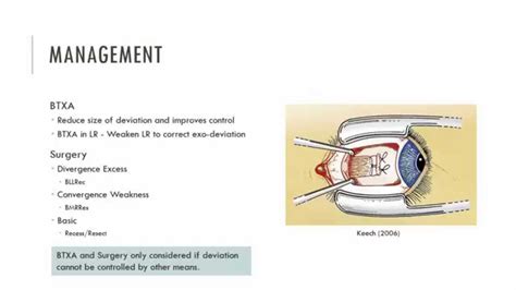 Exophoria Management - YouTube