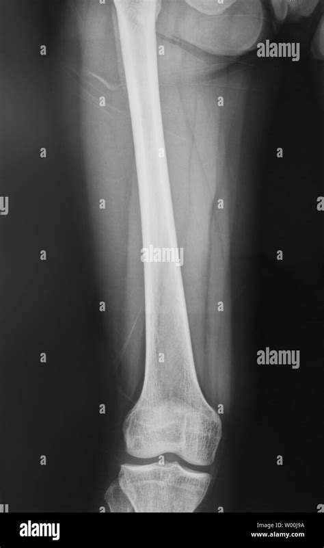 Rayos x de rodilla normal fotografías e imágenes de alta resolución - Alamy