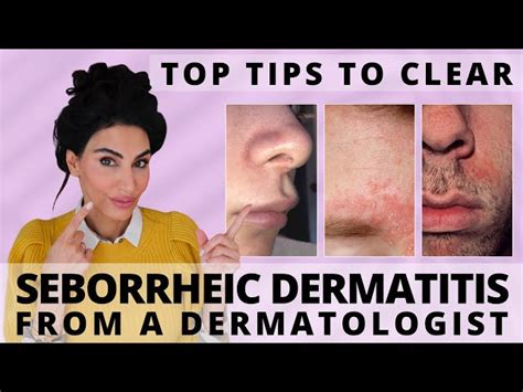 How To CLEAR SEBORRHEIC DERMATITIS On The Face| Dr Dray, 48% OFF