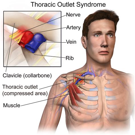 Rib Removal Surgery - Cost, Importance and Risks - Sutured