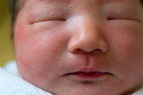 Neonatal Acne: How to Identify and Treat Your Baby's Spots - LittleOneMag