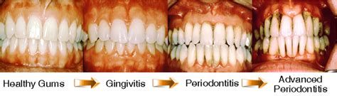 Smoking's Effect on your Oral Health - Rizzo Dental Group