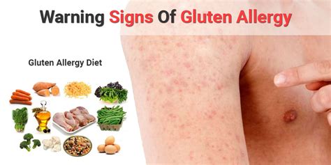 Gluten Allergy