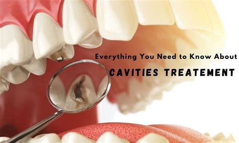 Everything You Need to Know About Cavities Treatment – Richardson's ...