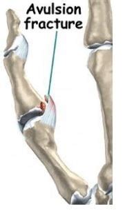 Avulsion Fracture - Ankle, Foot, Hip, What is?, Symptoms, Causes, Treat