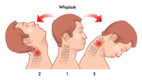 Auto Accidents and Chiropractic: Whiplash