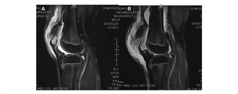 (A) Sagittal T2 MRI of the right knee. (B) Sagittal T2 MRI of the left ...