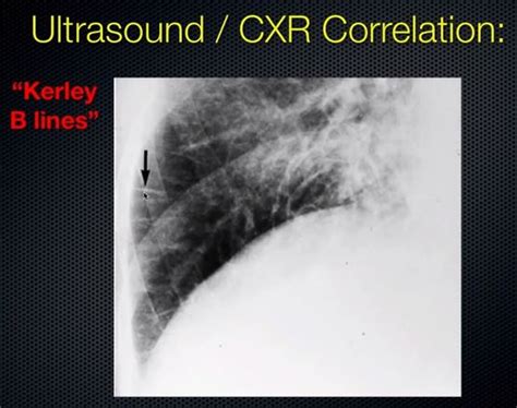 Kerley B Lines Cxr : Septal lines in lung | Radiology Reference Article ...