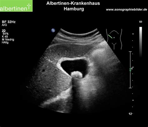 Chronic Cholecystitis - DocCheck