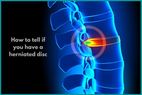 What Does It Mean When A Disc Is Herniated at Cecelia Frederick blog