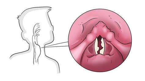 The 4 Underlying Causes of a Hoarse Voice | The voice, Pathology, Make ...